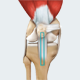 ACL Reconstruction Patellar Tendon