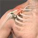 Clavicle Fracture