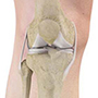 Osteonecrosis of the Knee