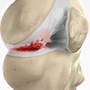 Knee Arthritis Management