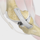 Medial Collateral Ligament Reconstruction