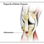 Osgood Schlatter Disease