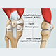 Patellofemoral Pain Syndrome