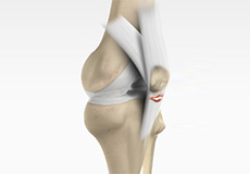 Subluxation