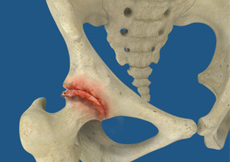 Rheumatoid Arthritis